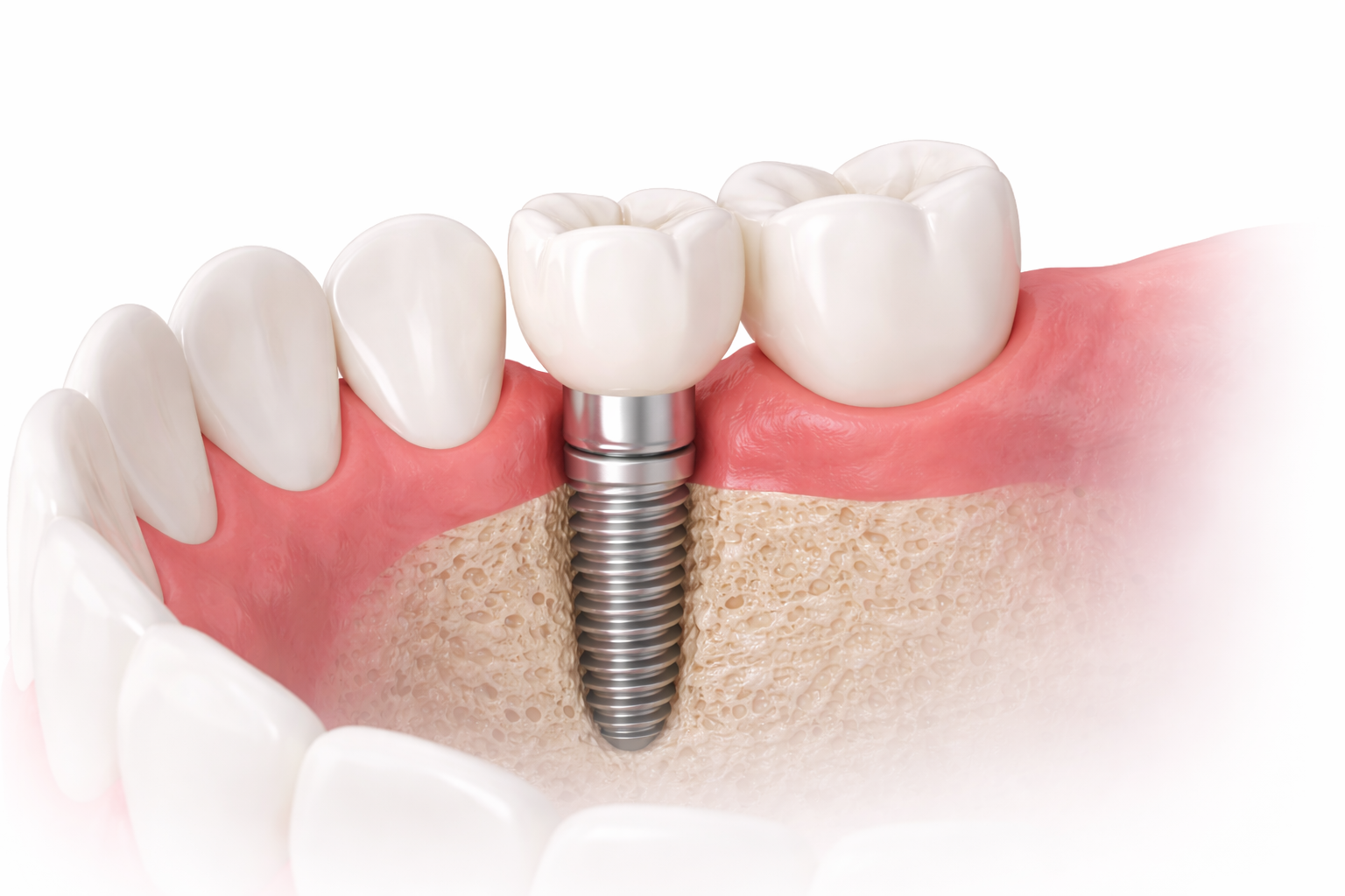 Implantate Materialien