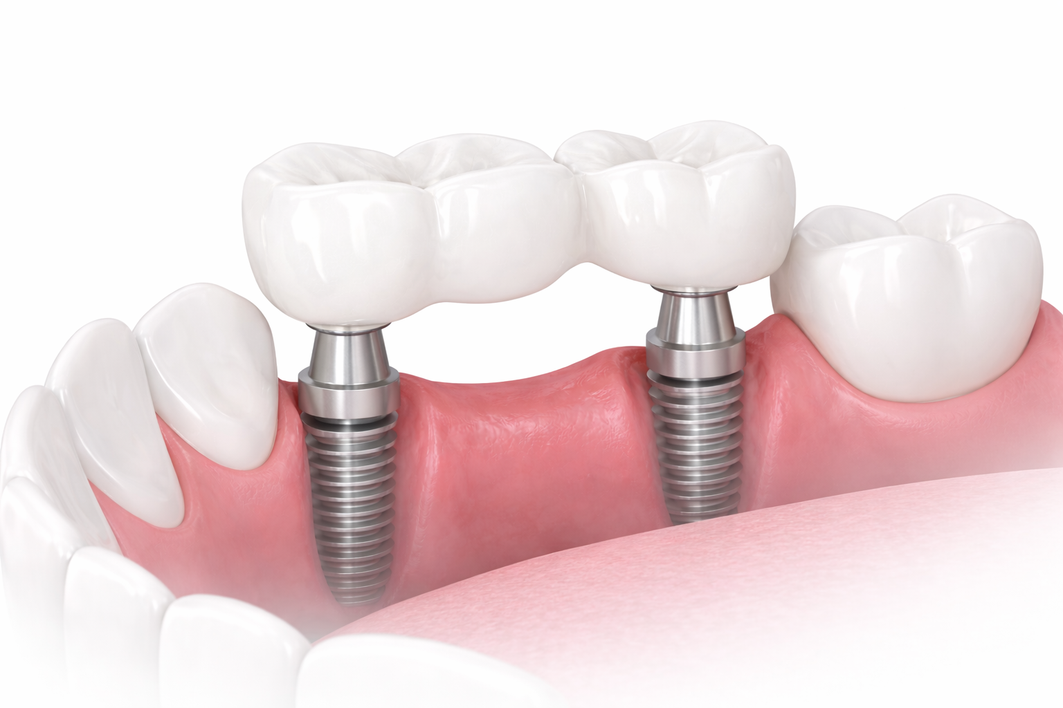Implantatgetragene Brücken